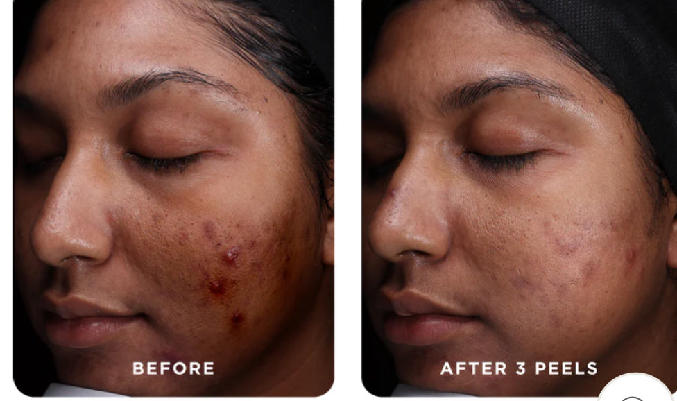 VI Peel Purify with Precision +Peptides Full kit Exp 08/2027