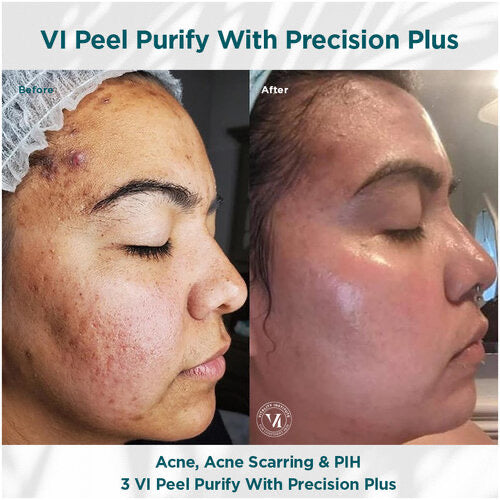 VI Peel Purify with Precision +Peptides Full kit Exp 08/2027