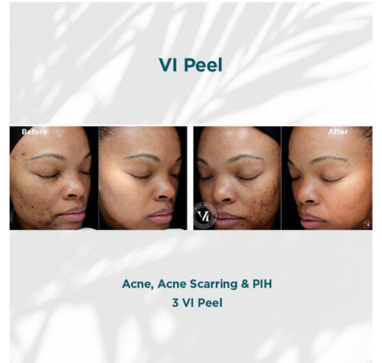 Buy Online Premium Quality VI Peel Original Kit | Shop for the Best Anti-aging Skincare Products - Ara by Ageless